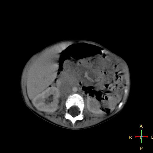 File:Neuroblastoma (Radiopaedia 24751-25016 D 20).jpg
