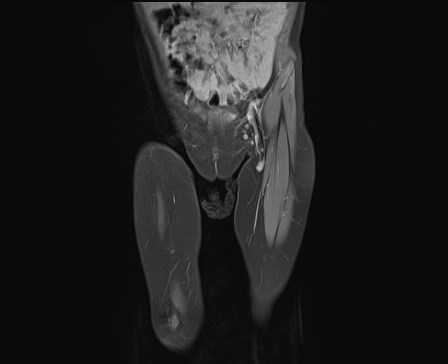 File:Neuroblastoma with bone metastases (Radiopaedia 67080-76414 E 4).jpg