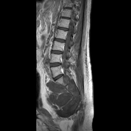 File:Neurofibromatosis type 1- extensive spinal involvement and Christmas tree sign (Radiopaedia 60610-68332 Sagittal T1 C+ 9).jpg