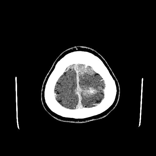 File:Neurofibromatosis type 2 (Radiopaedia 25389-25637 Axial C+ 94).jpg