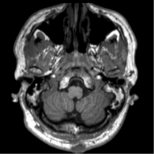 File:Neurofibromatosis type 2 (Radiopaedia 44936-48838 Axial T1 13).png