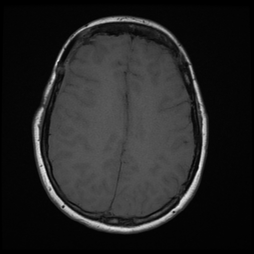 File:Neurofibromatosis type 2 (Radiopaedia 45229-49247 Axial T1 15).png