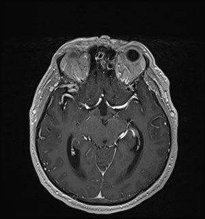 Neurofibromatosis type 2 (Radiopaedia 79097-92049 Axial T1 C+ 90).jpg