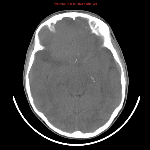 File:Neurofibromatosis type 2 (Radiopaedia 8953-9732 Axial non-contrast 17).jpg