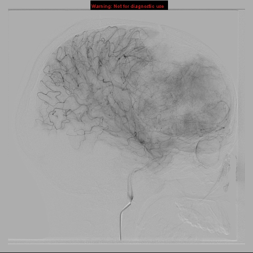File:Neurofibromatosis type 2 (Radiopaedia 8953-9733 C 11).jpg