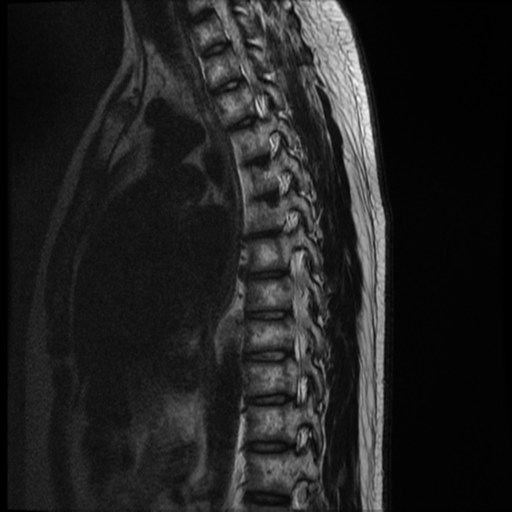 File:Neurofibromatosis type 2 (spinal manifestations) (Radiopaedia 53943-60070 C 5).png