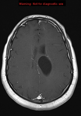 File:Neuroglial cyst (Radiopaedia 10713-11184 Axial T1 C+ 9).jpg
