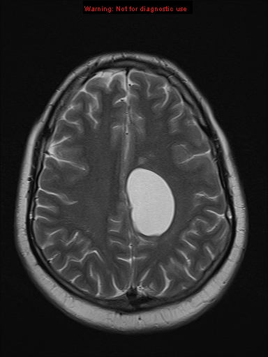 File:Neuroglial cyst (Radiopaedia 10713-11184 Axial T2 7).jpg