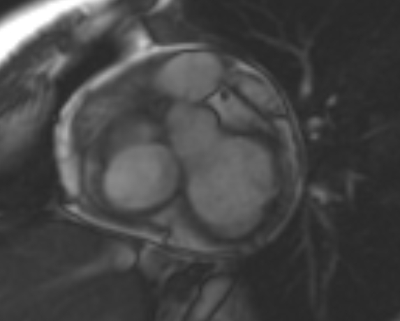 File:Non-compaction of the left ventricle (Radiopaedia 69436-79314 Short axis cine 220).jpg
