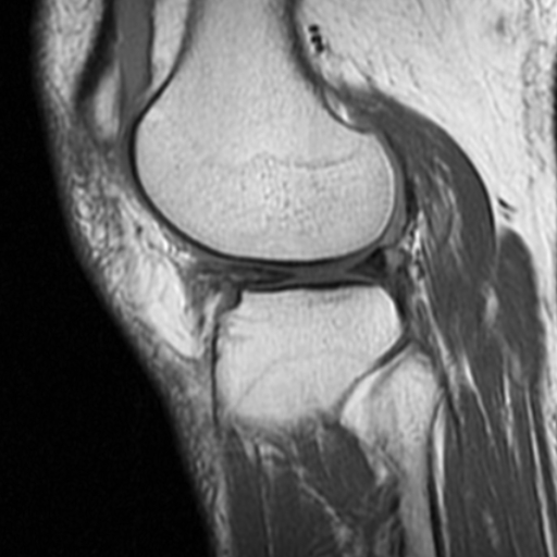 File:Non-displaced patella fracture (Radiopaedia 15932-15582 Sagittal T1 15).jpg