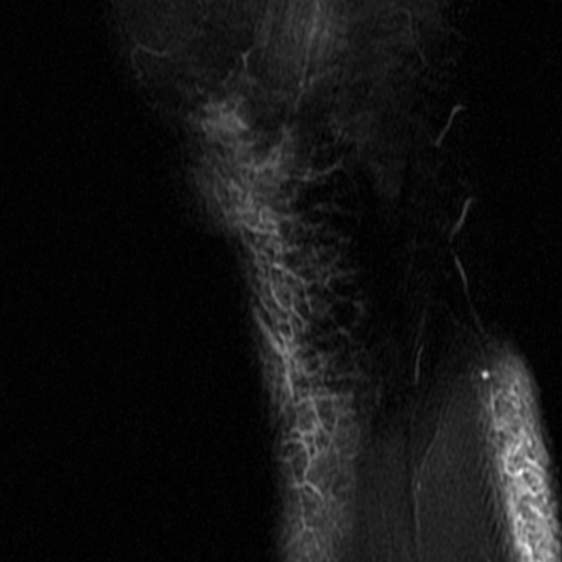 File:Non-displaced patella fracture (Radiopaedia 15932-15582 Sagittal T2 fat sat 19).jpg