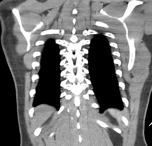 File:Normal CTA thorax (non ECG gated) (Radiopaedia 41750-44704 B 72).png