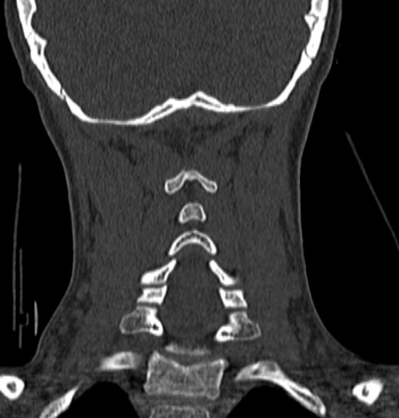 File:Normal CT cervical spine - 12-year-old (Radiopaedia 55352-61775 Coronal bone window 154).jpg