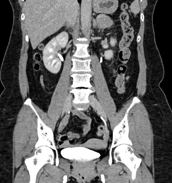 Normal CT intravenous urogram (Radiopaedia 39444-41759 A 281).jpg