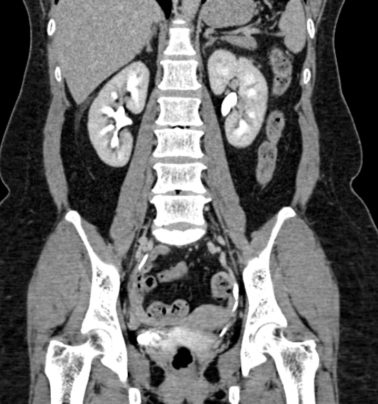 Normal CT intravenous urogram (Radiopaedia 39444-41759 A 295).jpg