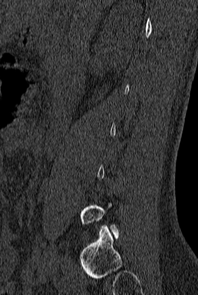 File:Normal CT lumbar spine (Radiopaedia 53981-60118 Sagittal bone window 15).jpg