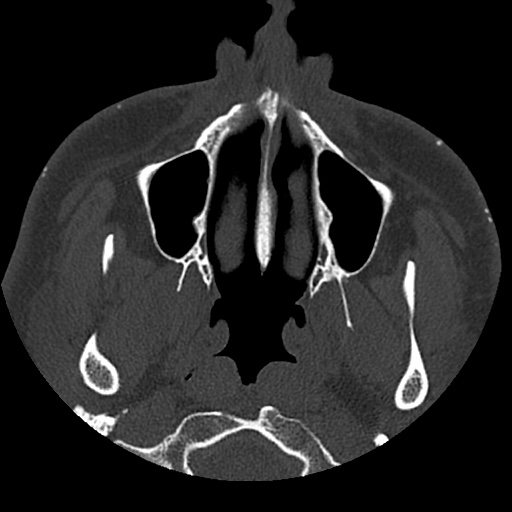 Normal CT paranasal sinuses (Radiopaedia 42286-45390 Axial bone window 89).jpg