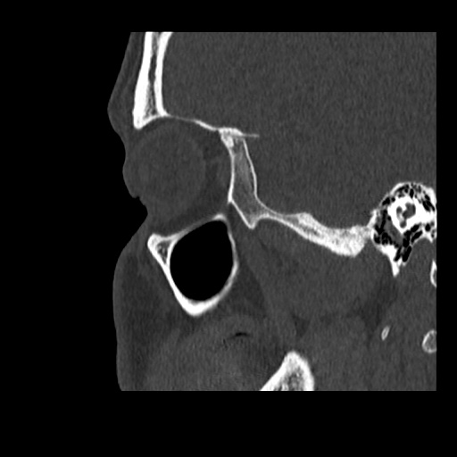 Normal CT paranasal sinuses (Radiopaedia 42286-45390 Sagittal bone window 17).jpg