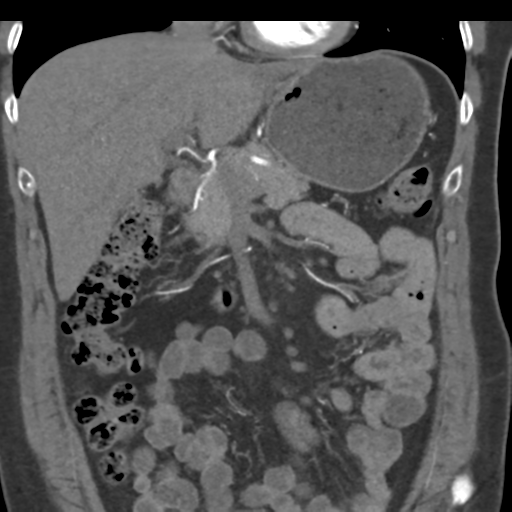 File:Normal CT renal artery angiogram (Radiopaedia 38727-40889 B 30).png