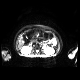 Normal MRI abdomen in pregnancy (Radiopaedia 88001-104541 Axial DWI 34).jpg
