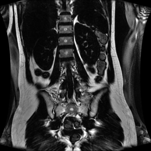Normal MRI abdomen in pregnancy (Radiopaedia 88001-104541 N 98).jpg