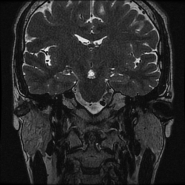 Normal MRI petrous (Radiopaedia 91317-108949 Coronal T2 34).jpg