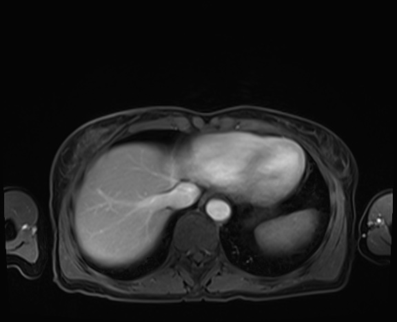 Normal adrenal glands MRI (Radiopaedia 82017-96004 K 10).jpg