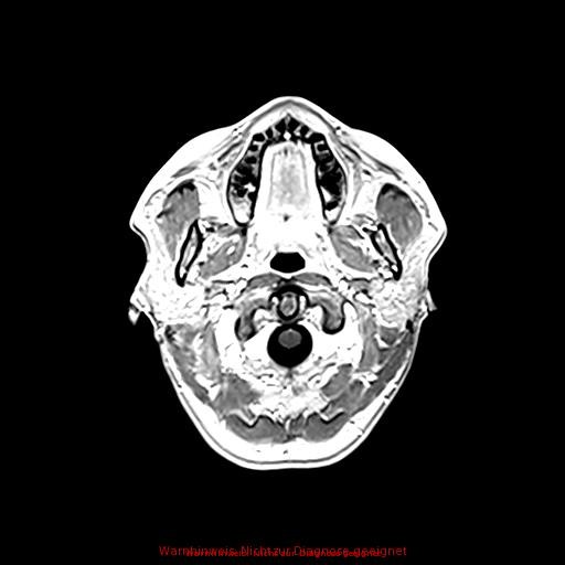 Normal adult brain MRI (non-enhanced and contrast-enhanced) (Radiopaedia 75262-86379 Axial T1 C+ 34).jpg