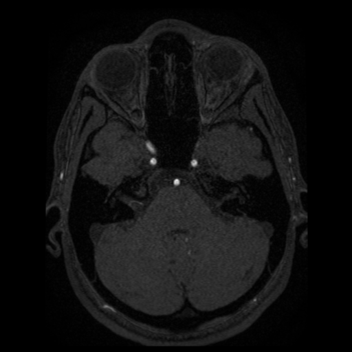Normal brain MRA (Radiopaedia 41046-43793 Axial MRA 84).png