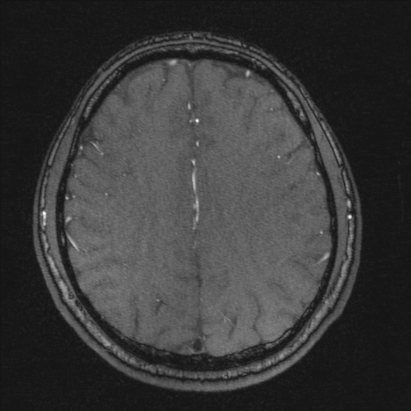 Normal brain MRI including MRA (Radiopaedia 48748-53763 Axial MRA 151).jpg