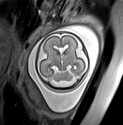 File:Normal brain fetal MRI - 22 weeks (Radiopaedia 50623-56050 Axial T2 Haste 7).jpg