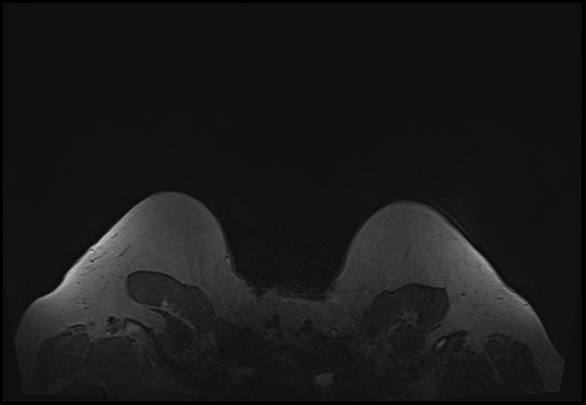 File:Normal breast MRI - dense breasts (Radiopaedia 80454-93850 Axial T1 219).jpg