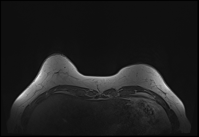 File:Normal breast MRI - dense breasts (Radiopaedia 80454-93850 Axial T1 30).jpg