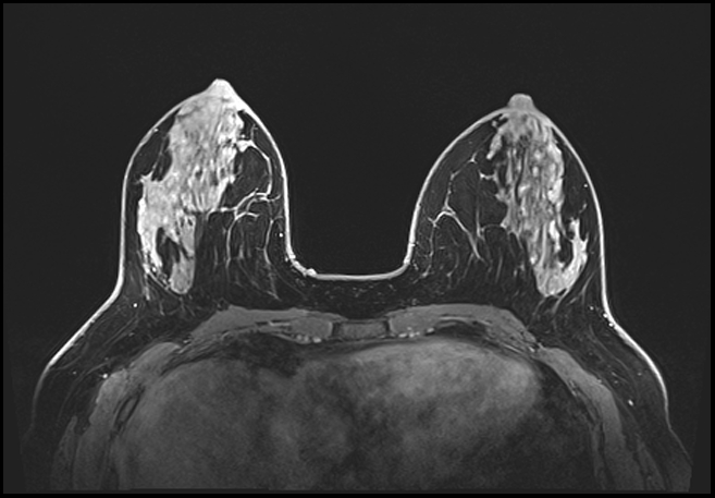 Normal breast MRI - dense breasts (Radiopaedia 80454-93850 C 89).jpg