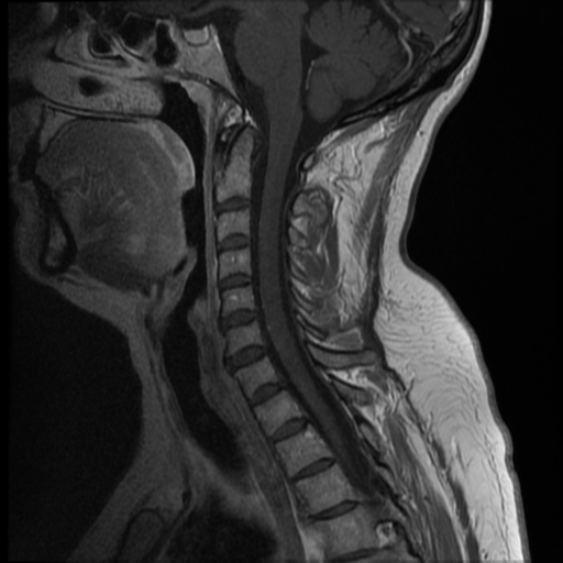 File:Normal cervical and thoracic spine MRI (Radiopaedia 35630-37156 Sagittal T1 C+ 6).png