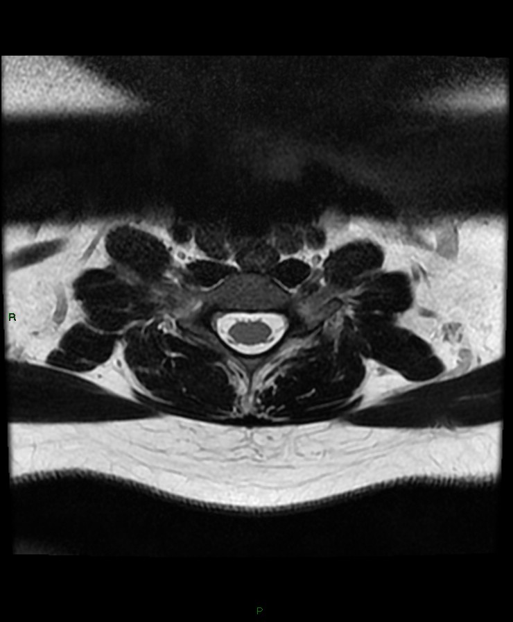 Normal cervical spine MRI (Radiopaedia 80146-93454 Axial T2 79).jpg