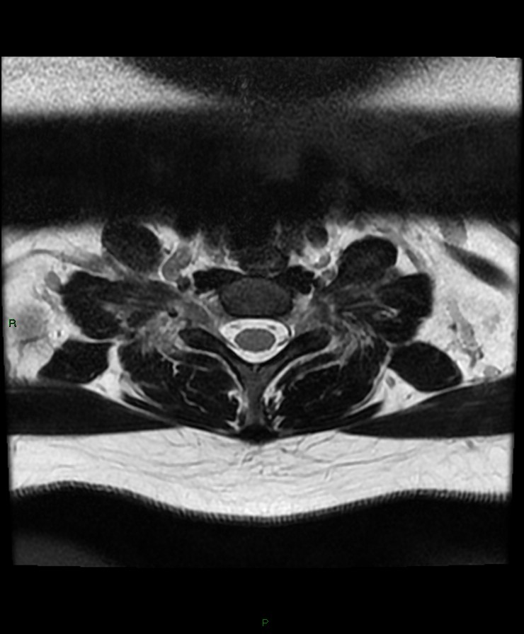 Normal cervical spine MRI (Radiopaedia 80146-93454 Axial T2 86).jpg