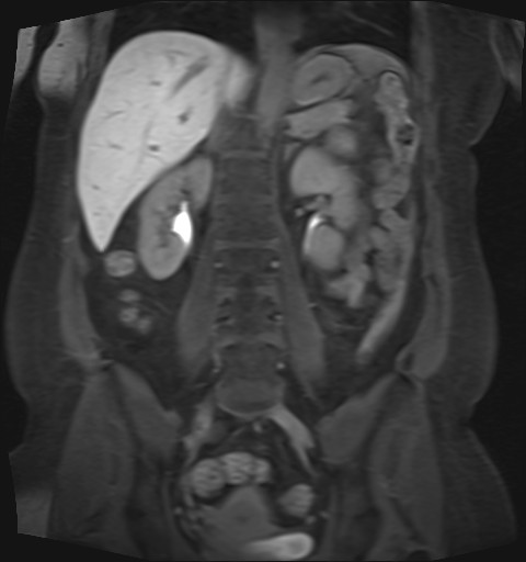 File:Normal hepatobiliary phase liver MRI (Radiopaedia 58968-66230 B 20).jpg