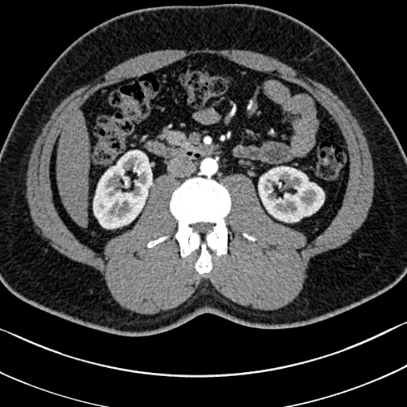 Normal kidneys on 4-phase CT study (Radiopaedia 25889-26038 B 54).jpg