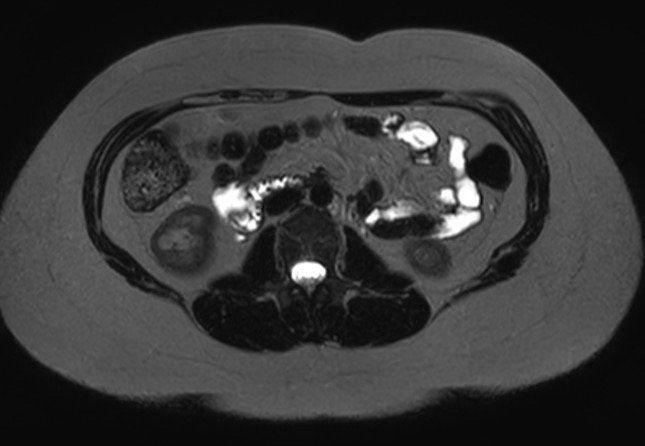 File:Normal liver MRI with Gadolinium (Radiopaedia 58913-66163 E 7).jpg