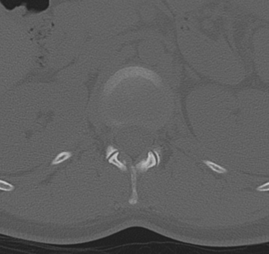 File:Normal lumbar spine CT (Radiopaedia 46533-50986 Axial bone window 6).png