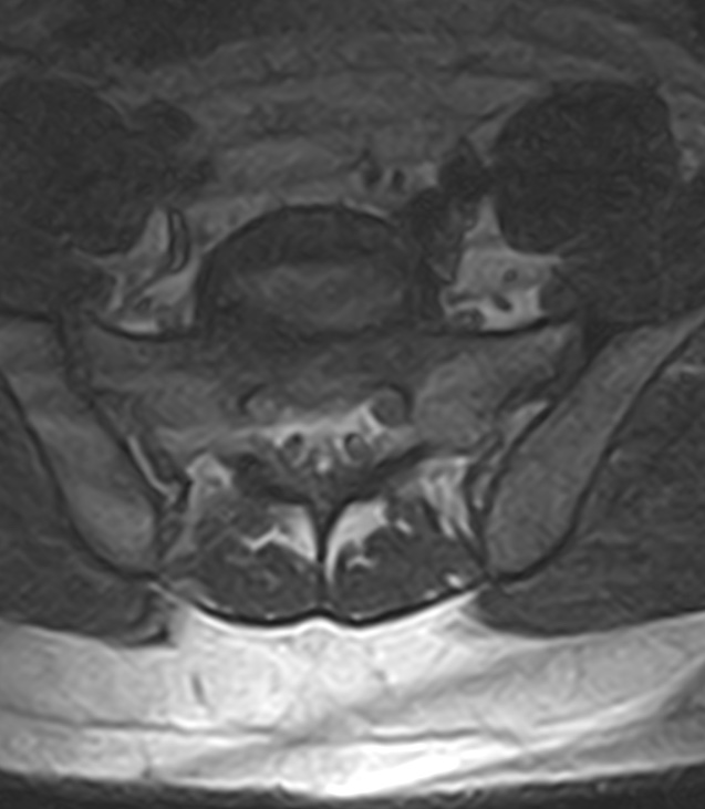 Normal lumbar spine MRI - low-field MRI scanner (Radiopaedia 40976-43699 Axial T2 91).jpg