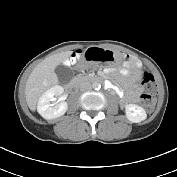 File:Normal multiphase CT liver (Radiopaedia 38026-39996 C 42).jpg