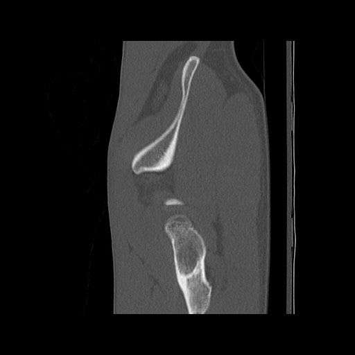 Normal pelvis (Radiopaedia 51473-57238 Sagittal bone window 25).jpg