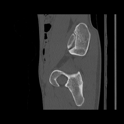 Normal pelvis (Radiopaedia 51473-57238 Sagittal bone window 47).jpg