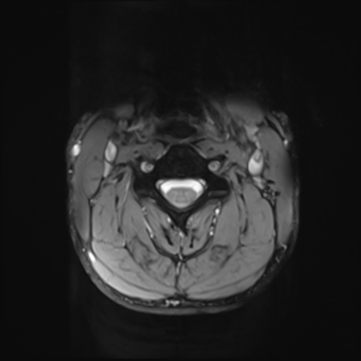 File:Normal trauma cervical spine (Radiopaedia 41017-43762 Axial T2 10).png
