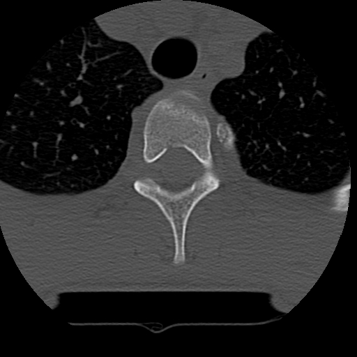 Normal trauma spine imaging (age 16) (Radiopaedia 45335-49358 Axial bone window 90).jpg