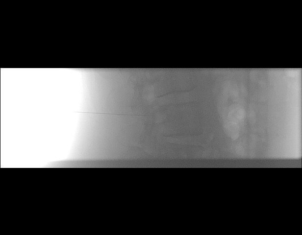 File:Oblique sublaminar lumbar puncture (Radiopaedia 90103-107280 A 5).jpeg
