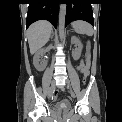 File:Obstructed kidney with perinephric urinoma (Radiopaedia 26889-27067 Coronal non-contrast 12).jpg