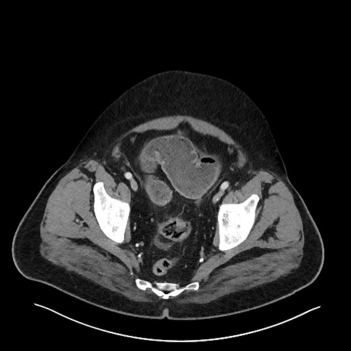 File:Obstructing sigmoid adenocarcinoma (Radiopaedia 58465-65619 A 143).jpg